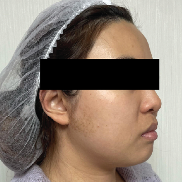 Titanium Lifting real case profile before treatment