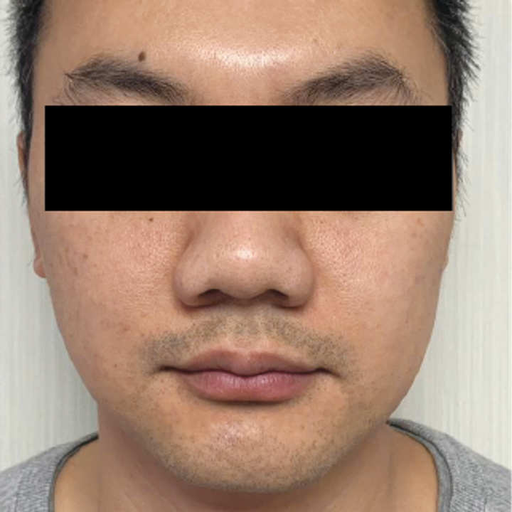 Titanium Lifting real case front view after third treatment